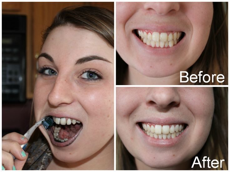 teeth-whitening-toothpaste